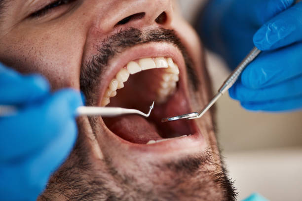 Best Emergency Dentist for Lost Fillings or Crowns in New Albany, IN